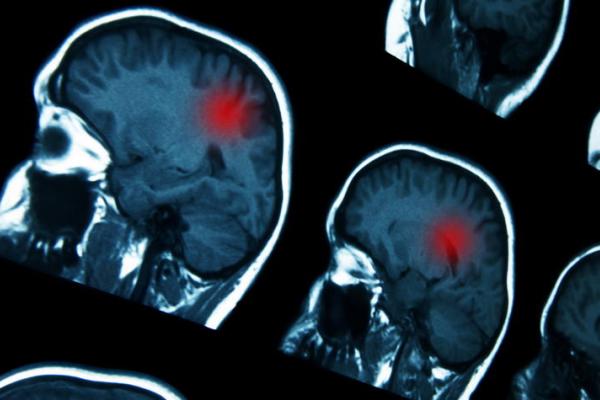 This is a photo of a brain scan, iStock/Getty Images Plus.